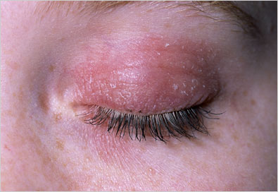Blepharitis. Treatment and Causes. Eye lid inflammation ...
